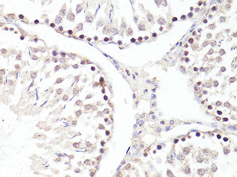Immunohistochemistry of paraffin-embedded Human colon carcinoma using FAM98A Polyclonal Antibody at dilution of  1:100 (40x lens).