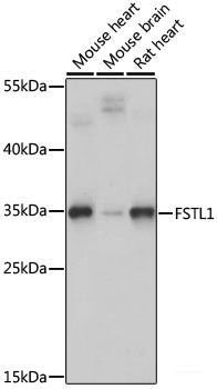 Immunohistochemistry of paraffin-embedded Human lung cancer using MAP3K3 Polyclonal Antibody at dilution of  1:100 (40x lens).