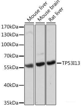 Immunohistochemistry of paraffin-embedded Human breast cancer using Androgen Receptor Polyclonal Antibody at dilution of  1:150 (40x lens).