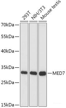Immunohistochemistry of paraffin-embedded Human liver cancer using SMAD7 Polyclonal Antibody at dilution of  1:100 (40x lens).