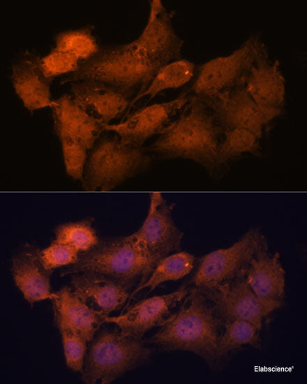 Immunohistochemistry of paraffin-embedded Human lung cancer using MTIF2 Polyclonal Antibody at dilution of  1:100 (40x lens).