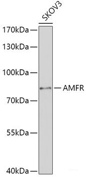 Immunohistochemistry of paraffin-embedded Human breast cancer using PDE4D Polyclonal Antibody at dilution of  1:100 (40x lens).