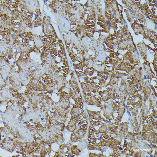 Immunohistochemistry of paraffin-embedded Human breast cancer using TERT Polyclonal Antibody at dilution of  1:100 (40x lens).