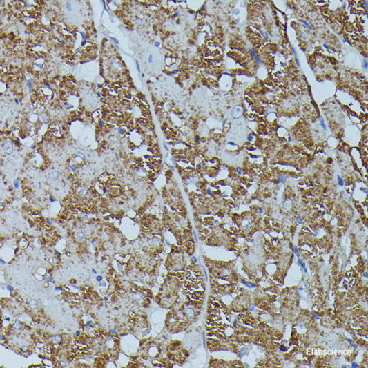 Immunohistochemistry of paraffin-embedded Human breast cancer using TERT Polyclonal Antibody at dilution of  1:100 (40x lens).