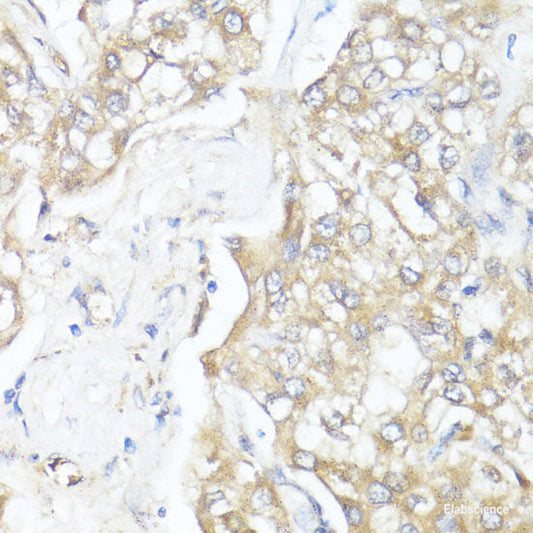 Immunohistochemistry of paraffin-embedded Human breast cancer using EIF4EBP1 Polyclonal Antibody at dilution of  1:100 (40x lens).
