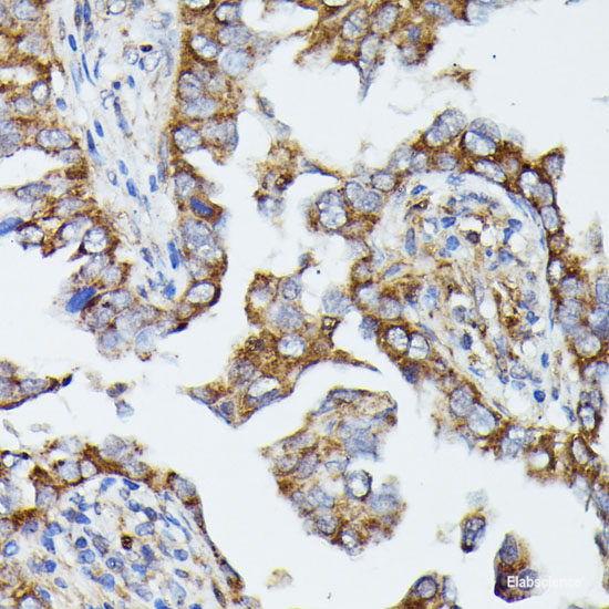 Immunohistochemistry of paraffin-embedded Human lung cancer using ERK1 / ERK2 Polyclonal Antibody at dilution of  1:200 (40x lens).