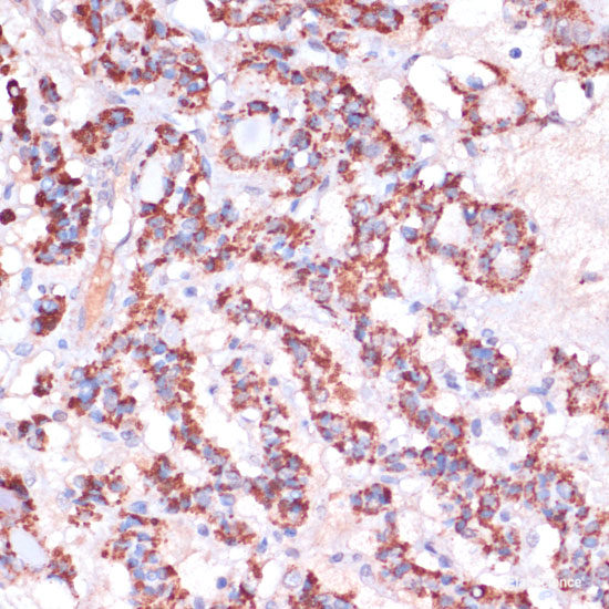 Immunohistochemistry of paraffin-embedded Human breast cancer using DNMT1 Polyclonal Antibody at dilution of  1:200 (40x lens).