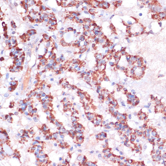 Immunohistochemistry of paraffin-embedded Human breast cancer using DNMT1 Polyclonal Antibody at dilution of  1:200 (40x lens).