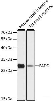 Immunohistochemistry of paraffin-embedded Human liver cancer using Bcl-2 Polyclonal Antibody at dilution of  1:200 (40x lens).