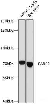 Immunohistochemistry of paraffin-embedded Human lung cancer using CAST Polyclonal Antibody at dilution of  1:100 (40x lens).