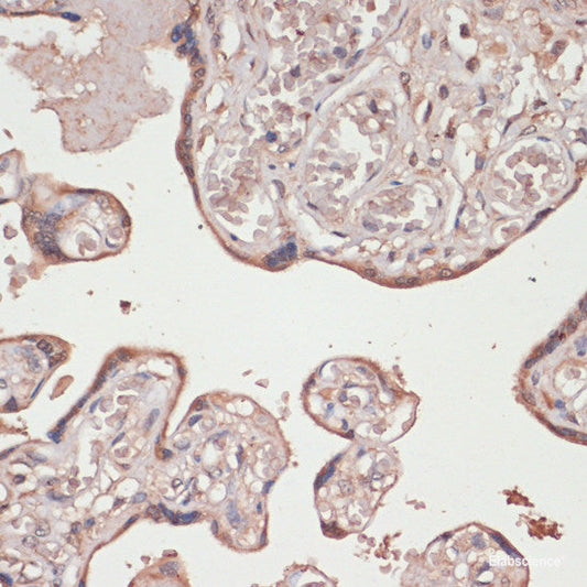 Immunohistochemistry of paraffin-embedded Human colon carcinoma using p53 Polyclonal Antibody at dilution of  1:200 (40x lens).