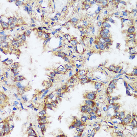 Immunohistochemistry of paraffin-embedded Human breast cancer using CADPS Polyclonal Antibody at dilution of  1:100 (40x lens).