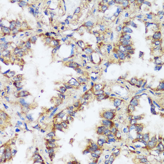 Immunohistochemistry of paraffin-embedded Human breast cancer using CADPS Polyclonal Antibody at dilution of  1:100 (40x lens).