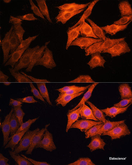 Immunohistochemistry of paraffin-embedded Human breast cancer using PRMT7 Polyclonal Antibody at dilution of  1:200 (40x lens).