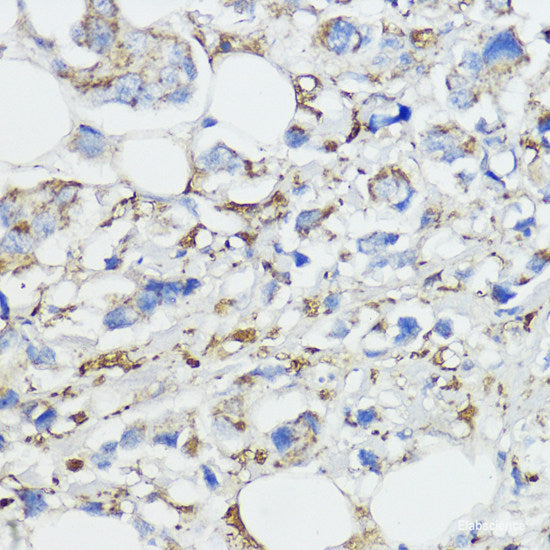 Immunohistochemistry of paraffin-embedded Human breast cancer using BRK1 Polyclonal Antibody at dilution of  1:100 (40x lens).