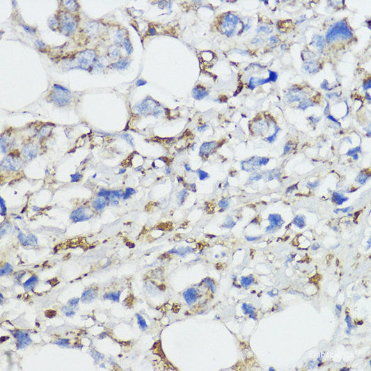 Immunohistochemistry of paraffin-embedded Human breast cancer using BRK1 Polyclonal Antibody at dilution of  1:100 (40x lens).