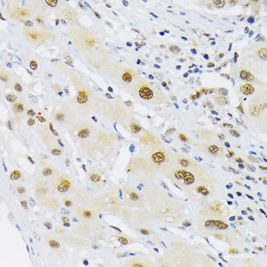 Immunohistochemistry of paraffin-embedded Human colon carcinoma using UBE2O Polyclonal Antibody at dilution of  1:100 (40x lens).