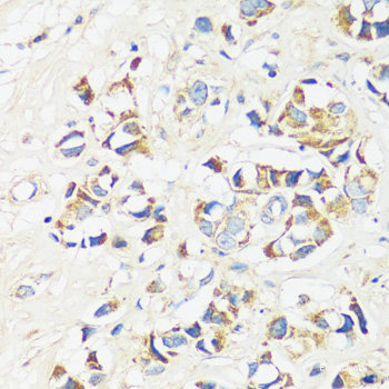Immunohistochemistry of paraffin-embedded Human breast cancer using BUB1B Polyclonal Antibody at dilution of  1:200 (40x lens).