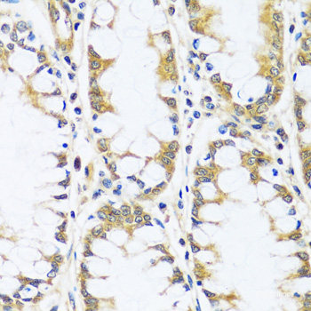 Immunohistochemistry of paraffin-embedded Human gastric cancer using PTGIR Polyclonal Antibody at dilution of  1:200 (40x lens).