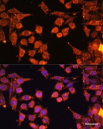 Immunohistochemistry of paraffin-embedded Human liver cancer using CES1 Polyclonal Antibody at dilution of  1:100 (40x lens).