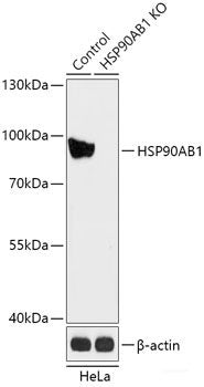 Immunohistochemistry of paraffin-embedded Human liver cancer using TIRAP Polyclonal Antibody at dilution of  1:200 (40x lens).