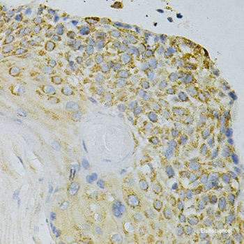 Immunohistochemistry of paraffin-embedded Human lung cancer using Ki67 Polyclonal Antibody at dilution of  1:200 (40x lens).