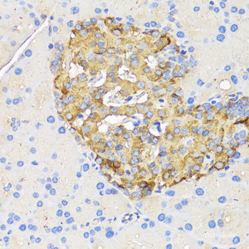 Immunohistochemistry of paraffin-embedded Human lung cancer using UHRF1 Polyclonal Antibody at dilution of  1:100 (40x lens).