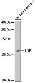 Immunohistochemistry of paraffin-embedded Human thyroid cancer using SNCG Polyclonal Antibody at dilution of  1:200 (40x lens).