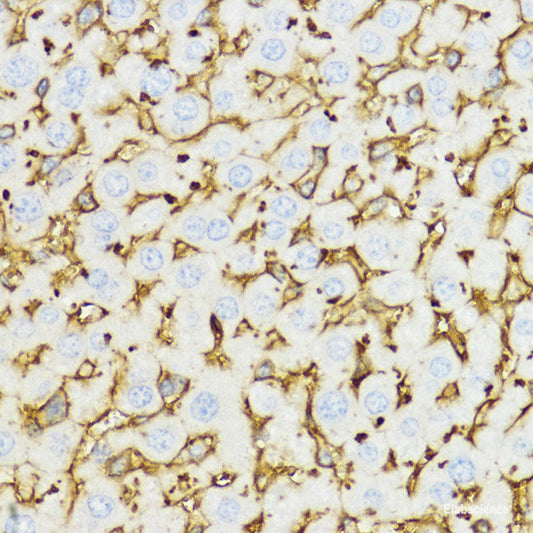 Immunohistochemistry of paraffin-embedded Human breast cancer using DGKQ Polyclonal Antibody at dilution of  1:100 (40x lens).
