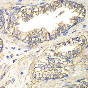 Immunofluorescence analysis of Human lung cancer cells using SCNN1A Polyclonal Antibody at dilution of  1:100. Blue: DAPI for nuclear staining.