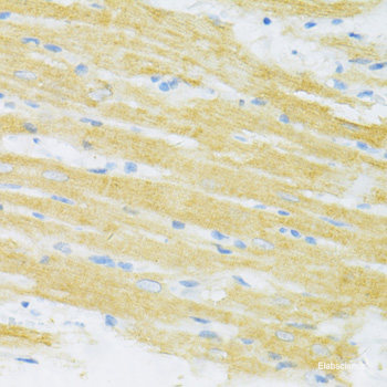 Immunohistochemistry of paraffin-embedded Human mammary cancer using ZEB1 Polyclonal Antibody at dilution of  1:200 (40x lens).