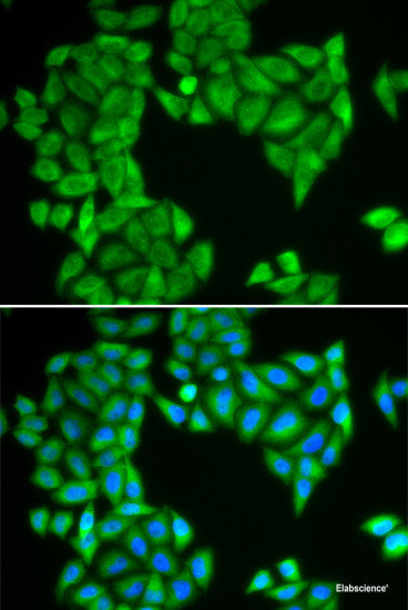 Immunohistochemistry of paraffin-embedded Human liver cancer using HAGH Polyclonal Antibody at dilution of  1:100 (40x lens).