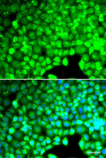Immunohistochemistry of paraffin-embedded Human well-differentiated squamous skin carcinoma using PHIP Polyclonal Antibody at dilution of  1:100 (40x lens).