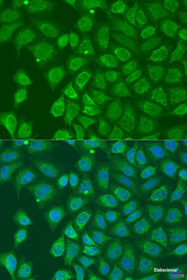 Immunohistochemistry of paraffin-embedded Human gastric cancer using NDUFS7 Polyclonal Antibody at dilution of  1:100 (40x lens).