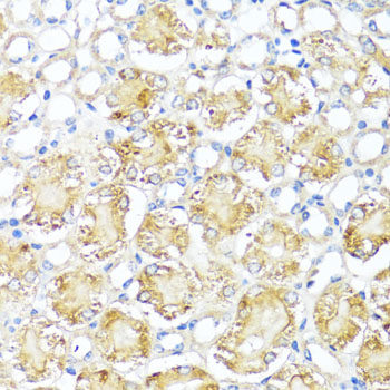 Immunohistochemistry of paraffin-embedded Human liver cancer using XPC Polyclonal Antibody at dilution of  1:100 (40x lens).
