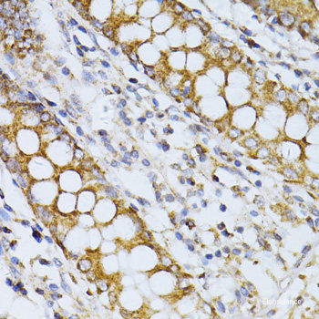 Immunohistochemistry of paraffin-embedded Human liver damage using ZBTB17 Polyclonal Antibody at dilution of  1:100 (40x lens).
