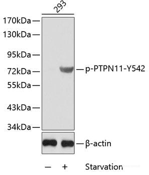Immunohistochemistry analysis of paraffin-embedded human lung cancer  using p27 Polyclonal Antibody at dilution of 1:200.