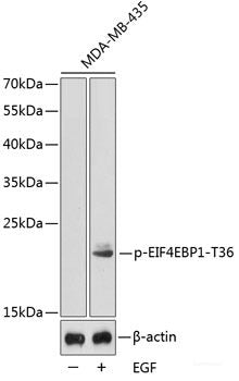 Immunohistochemistry analysis of paraffin-embedded human colon cancer  using MMP2 Polyclonal Antibody at dilution of 1:500.