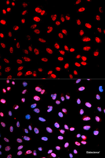 Immunohistochemistry analysis of paraffin-embedded human liver cancer   using DNMT1 Polyclonal Antibody at dilution of 1:300.