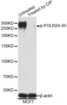 Immunohistochemistry analysis of paraffin-embedded human lung cancer  using IKK alpha Polyclonal Antibody at dilution of 1:300.