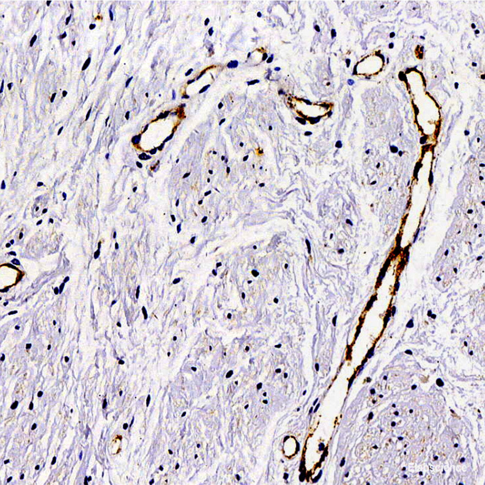 Immunohistochemistry analysis of paraffin-embedded human liver cancer   using VDAC1 Polyclonal Antibody at dilution of 1:200.