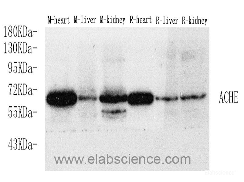 Immunohistochemistry analysis of paraffin-embedded human lung cancer  using p27 Polyclonal Antibody at dilution of 1:400.