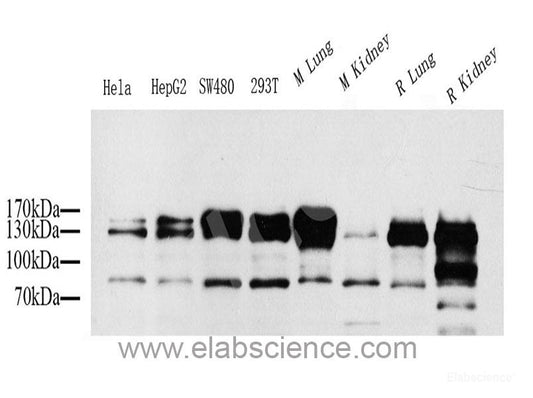 Immunohistochemistry analysis of paraffin-embedded human lung cancer   using ATF2 Polyclonal Antibody at dilution of 1:400.