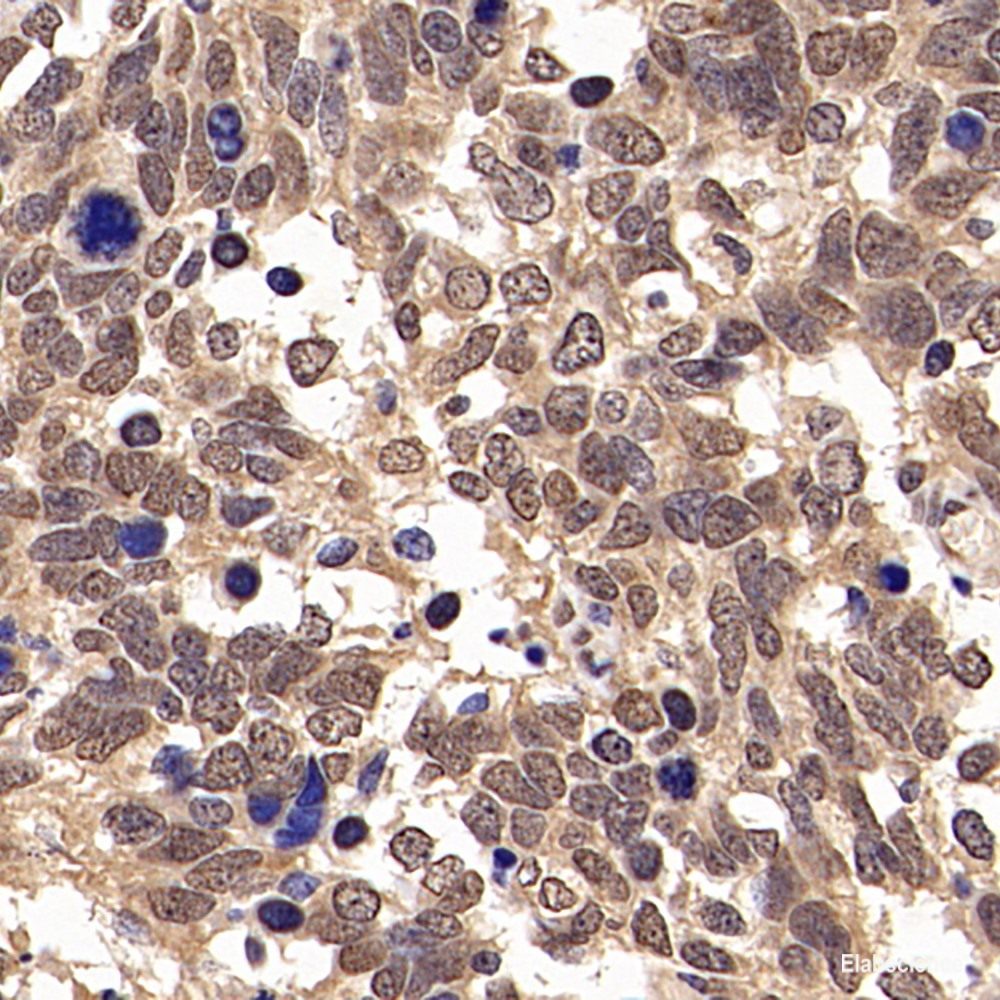 Immunohistochemistry analysis of paraffin-embedded human liver  cancer  using ITGAV Polyclonal Antibody at dilution of 1:300.