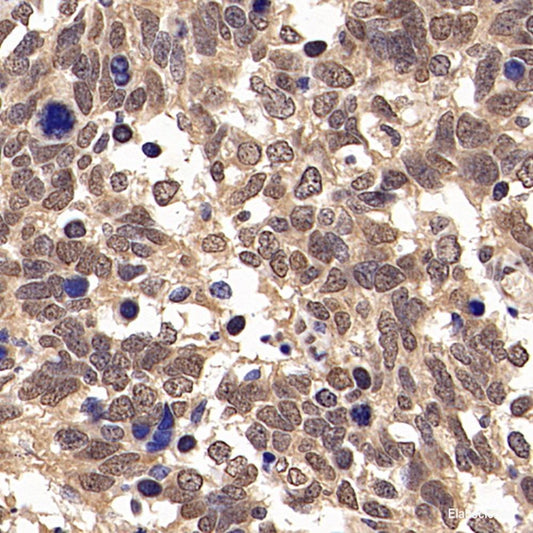 Immunohistochemistry analysis of paraffin-embedded human liver  cancer  using ITGAV Polyclonal Antibody at dilution of 1:300.