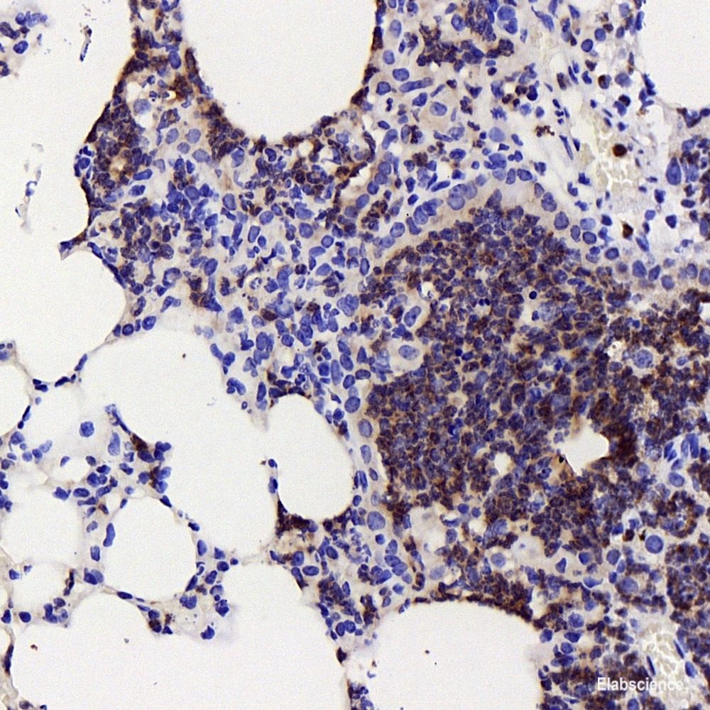 Immunohistochemistry analysis of paraffin-embedded human liver cancer   using TEK Polyclonal Antibody at dilution of 1:200.
