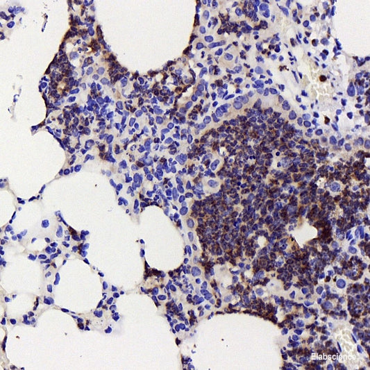 Immunohistochemistry analysis of paraffin-embedded human liver cancer   using TEK Polyclonal Antibody at dilution of 1:200.