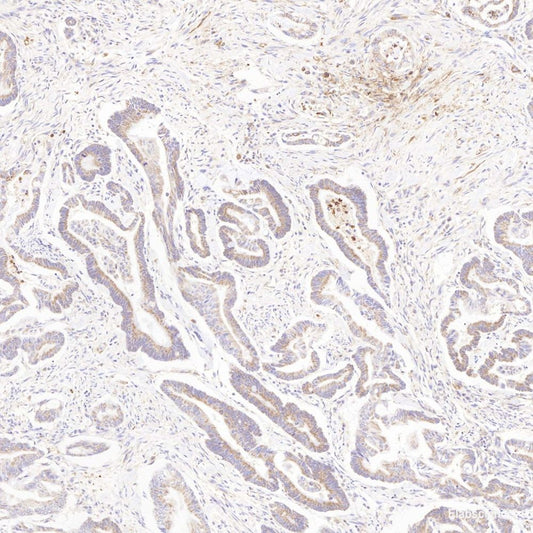 Immunohistochemistry analysis of paraffin-embedded human lung cancer   using CREB1 Polyclonal Antibody at dilution of 1:200.