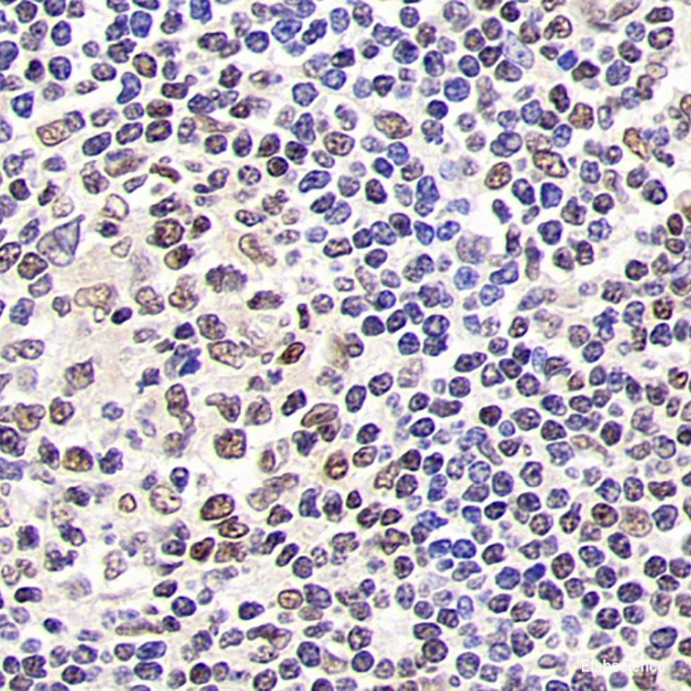 Immunohistochemistry analysis of paraffin-embedded human lung cancer  using BSG Polyclonal Antibody at dilution of 1:200.