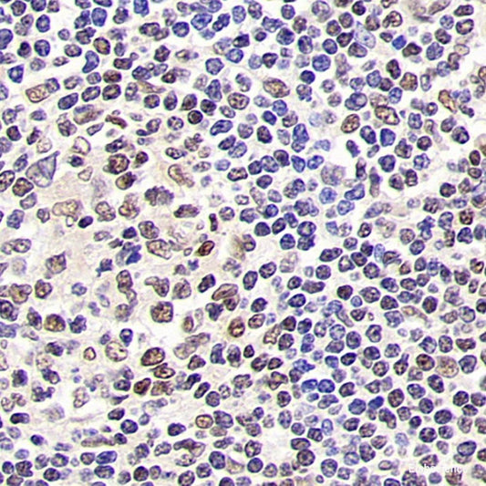 Immunohistochemistry analysis of paraffin-embedded human lung cancer  using BSG Polyclonal Antibody at dilution of 1:200.